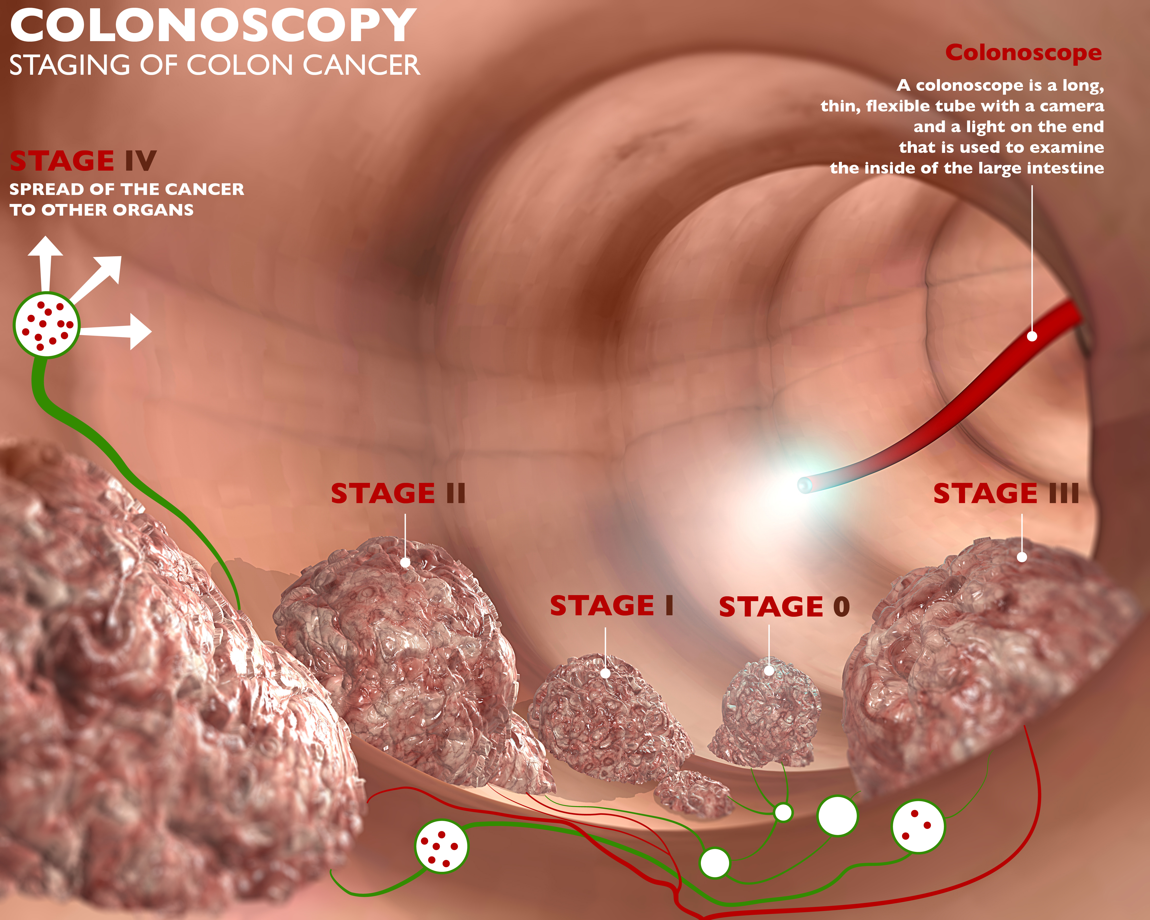 prevalence-of-nonpolypoid-flat-and-depressed-colorectal-neoplasms-in