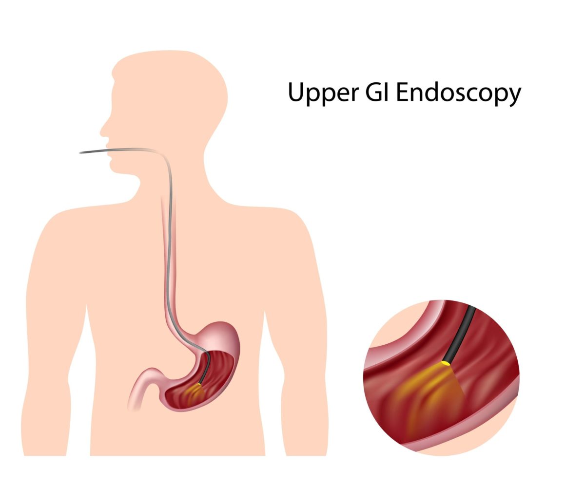 What is the Procedure for an Endoscopy?