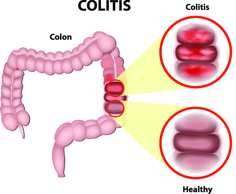 What is the Best Treatment for Colitis?