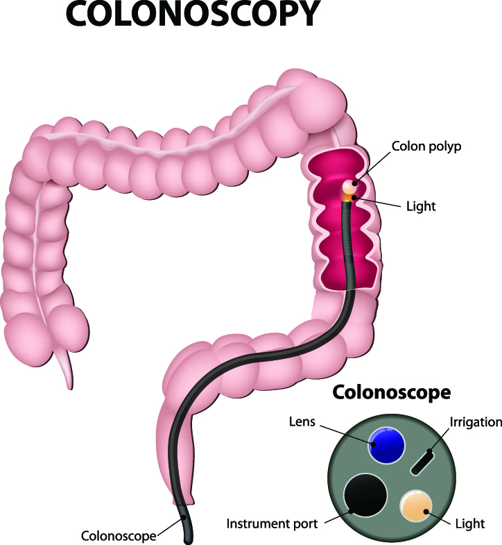 What Can Be Found During a Colonoscopy?